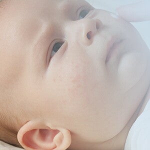 Baby allergies – Ask the expert