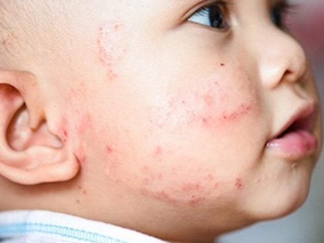 https://www.babyandme.nestle.com.sg/is-partially-hydrolyzed-protein-suitable-for-your-baby https://www.babyandme.nestle.com.sg/is-partially-hydrolyzed-protein-suitable-for-your-baby